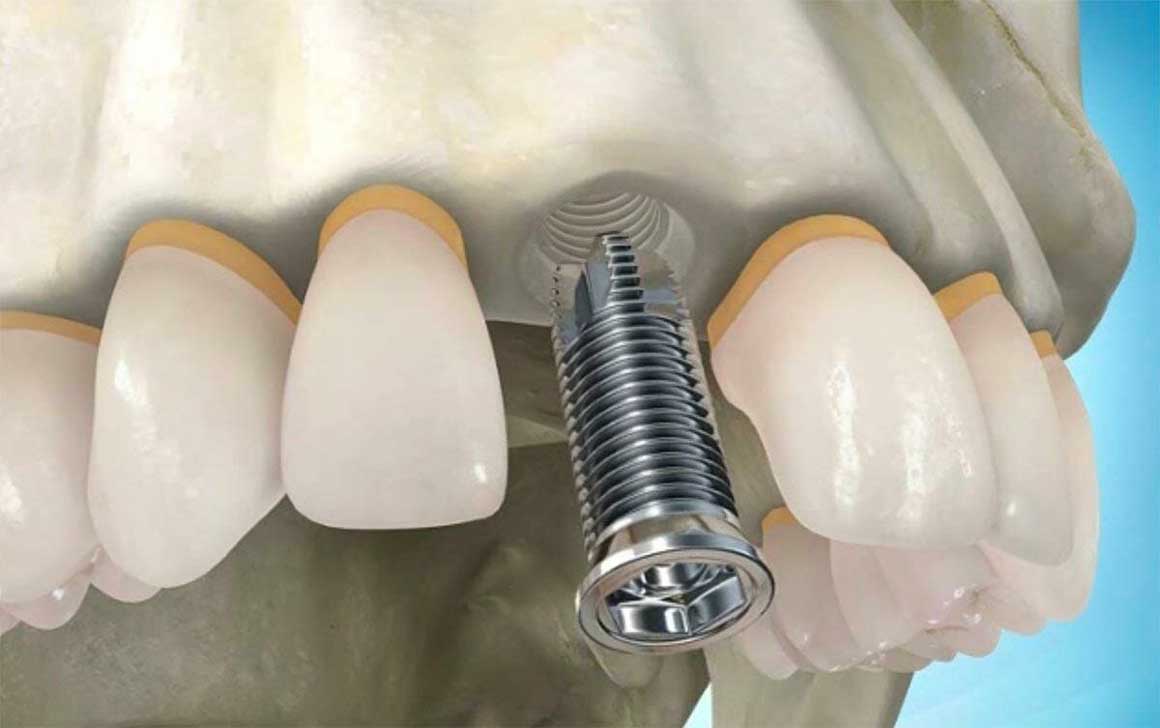 один зуб имплантация