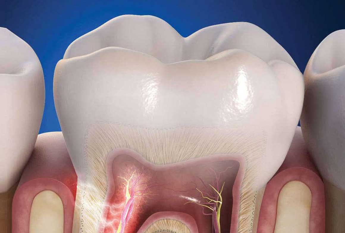 Гиперестезия зубов