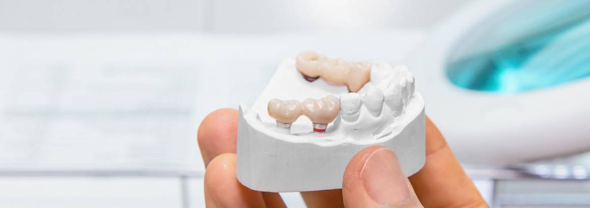 Альтернатива имплантации зубов 