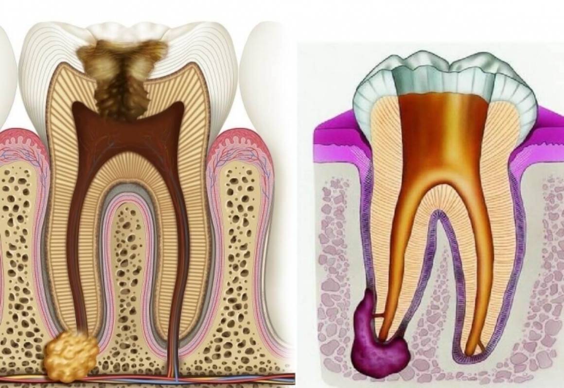 Гранулема на корне зуба