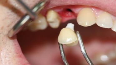 Пересадка зуба как альтернатива имплантации