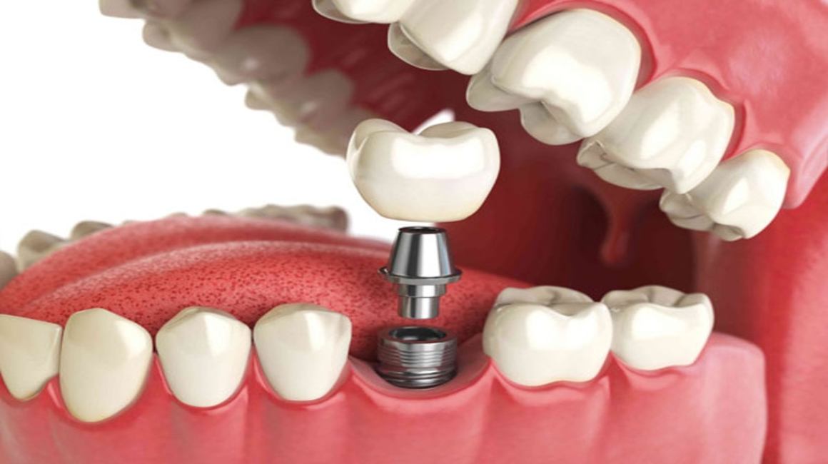Имплантация зубов при пародонтите и пародонтозе