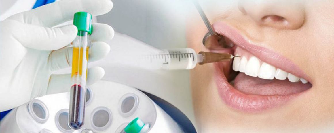 Плазмолифтинг в стоматологии 