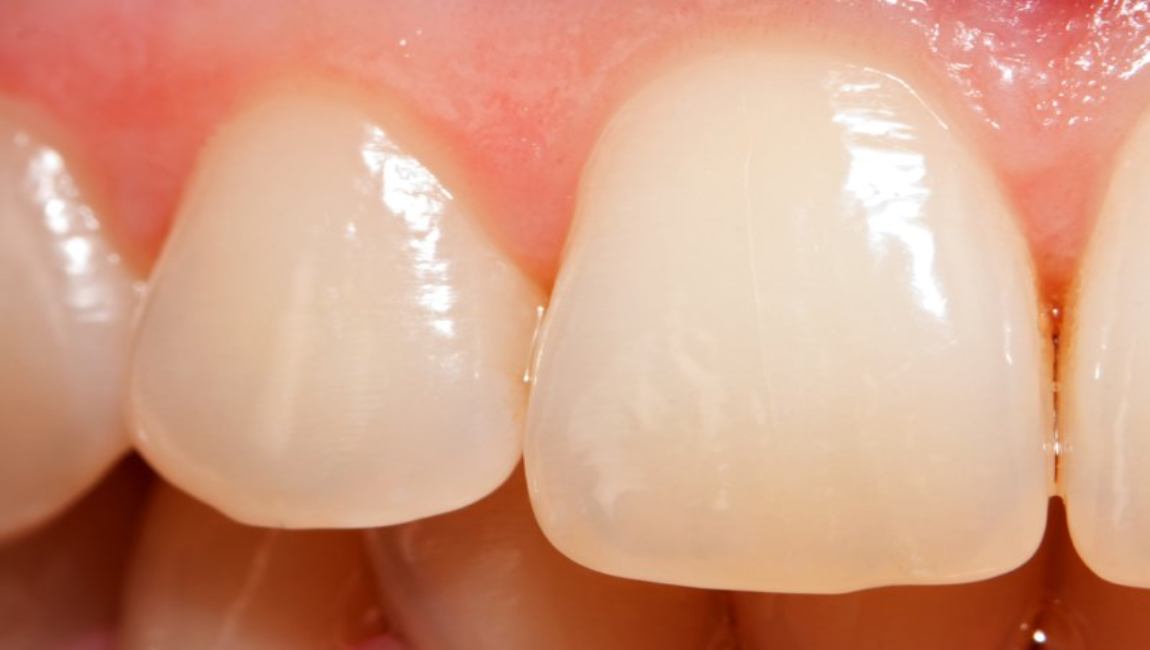 Трещины на зубах