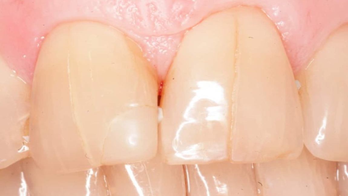 Лечение трещин на зубах