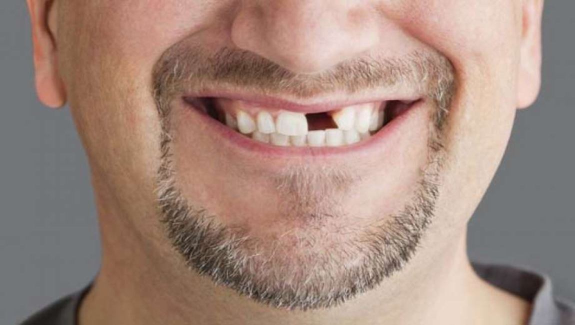 Почему выпадают зубы: основные причины и способы предотвращения