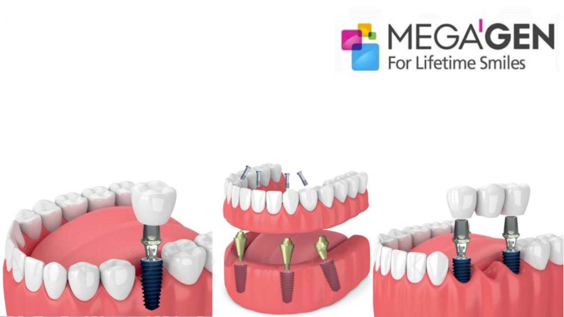 Преимущества зубных имплантов MegaGen