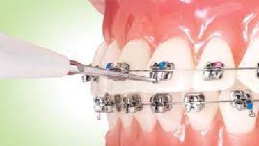 Особенности брекетов Ortho