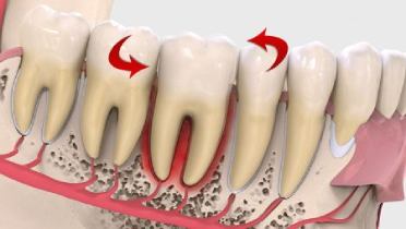 Нужно ли удалять подвижный зуб у взрослого?