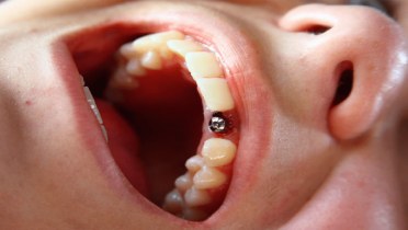 Особенности имплантации зубов на верхней челюсти.
