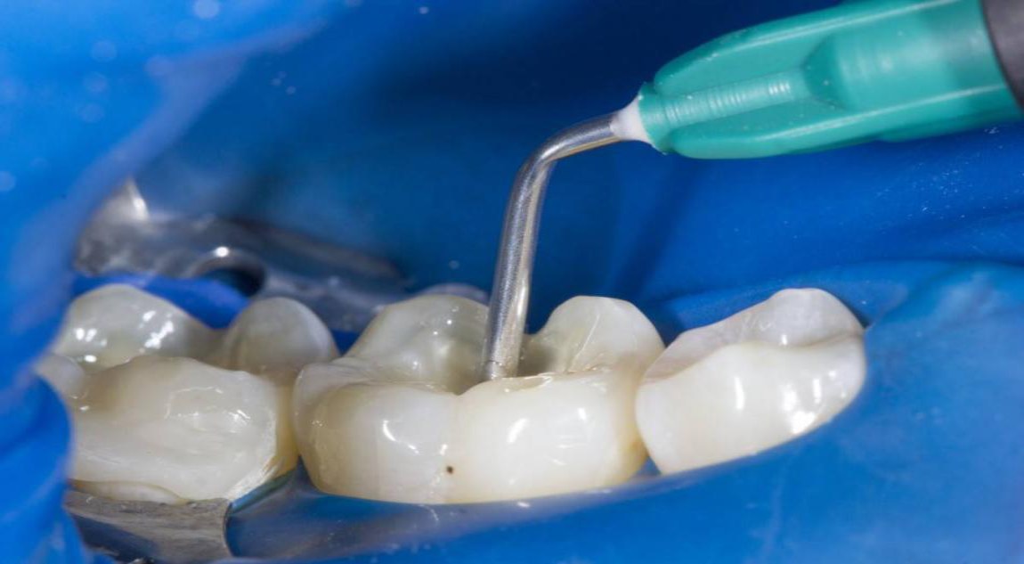 Почему нельзя держать мышьяк в зубе дольше нормы