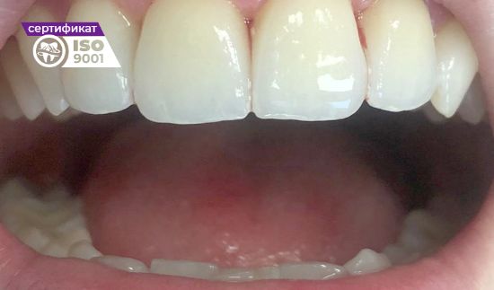 Пример работы по устранению неправильного положения зубов после