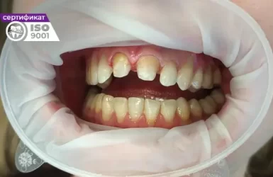 Пример работы по установке коронок E-max на передние зубы