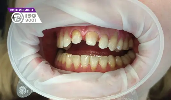Пример работы по установке коронок E-max на передние зубы до