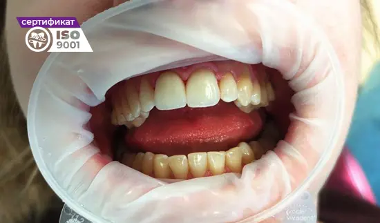Пример работы по установке коронок E-max на передние зубы после