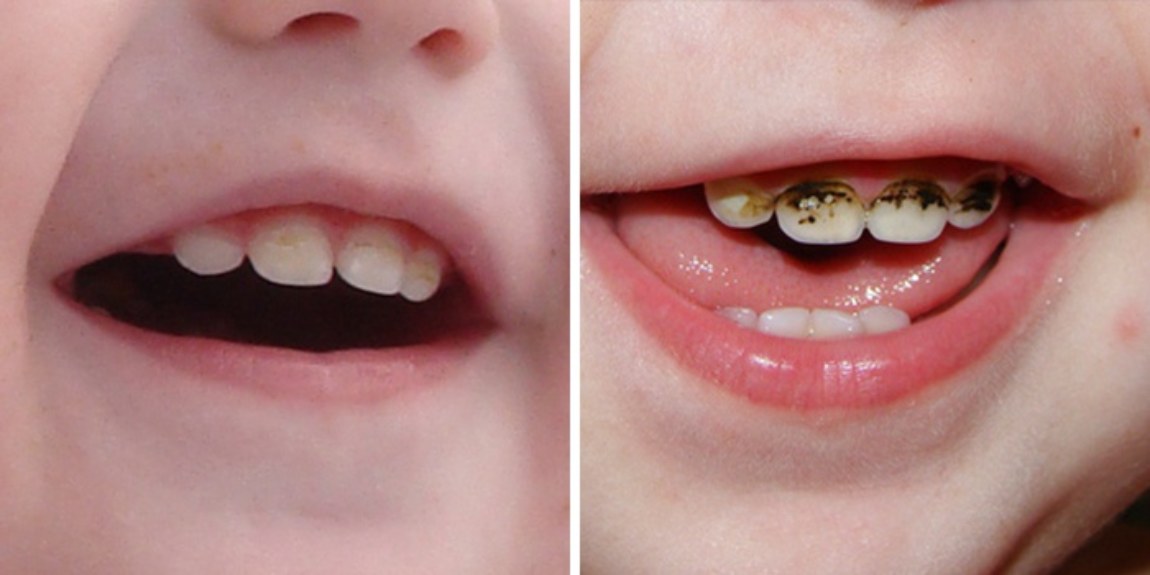 Серебрение зубов у детей
