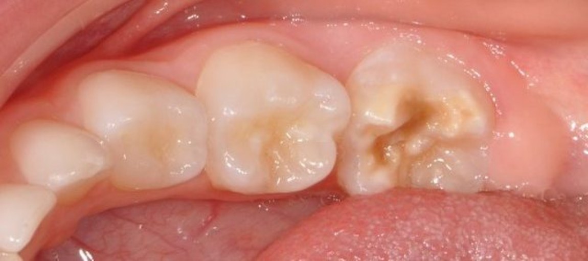 Гипоминерализация постоянных зубов