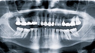Панорамный снимок при имплантации зубов