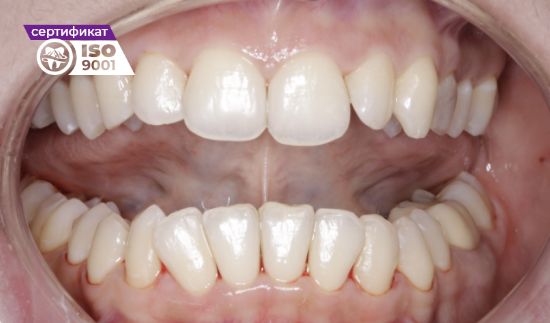 Пример работы по устранению налета на зубах после