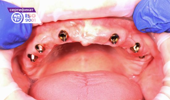 Пример протезирования на верхней челюсти на 6 имплантах до