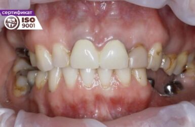 Пример работы по установке циркониевых коронок на имплантах на жевательные зубы до