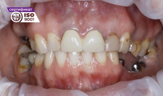 Пример работы по установке циркониевых коронок на имплантах на жевательные зубы до