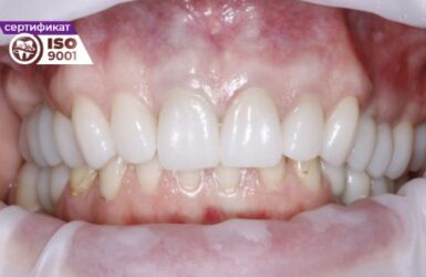Пример работы по установке циркониевых коронок на имплантах на жевательные зубы после