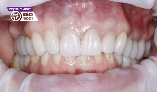 Пример работы по установке циркониевых коронок на имплантах на жевательные зубы после