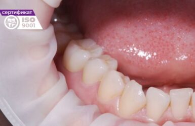 Пример протезирования 46 и 47 зубов после